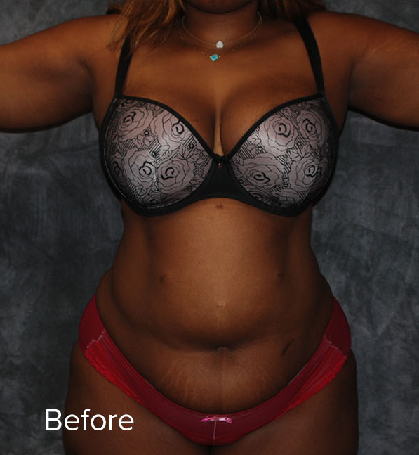 Tummy Tuck