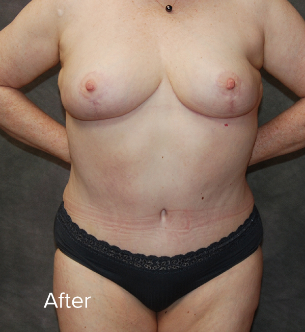 Tummy Tuck