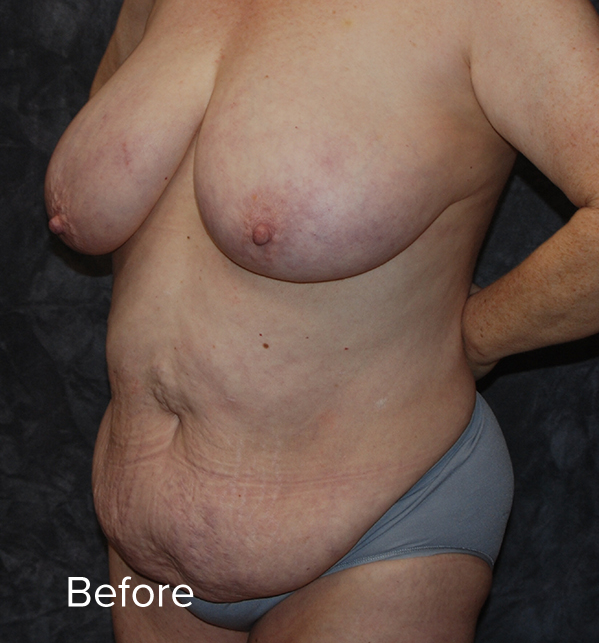 Tummy Tuck