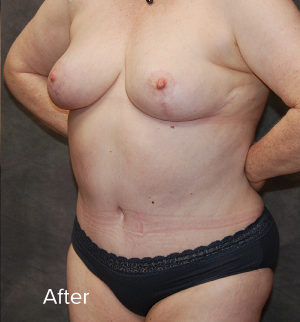 Tummy Tuck