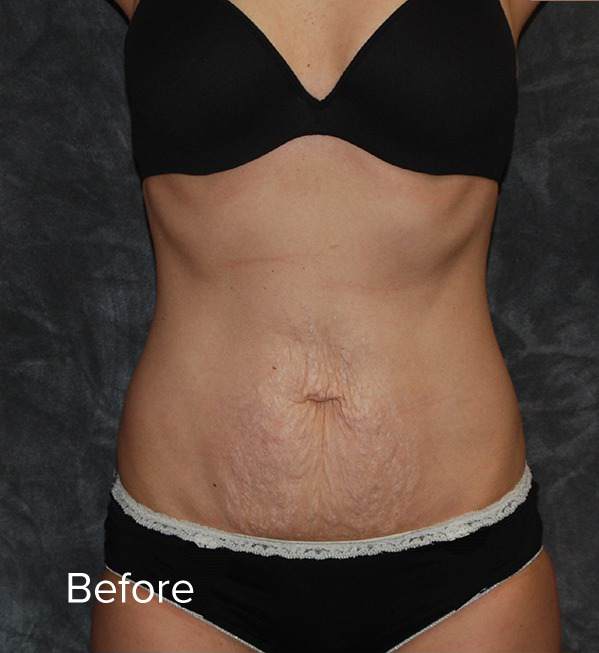 Tummy Tuck