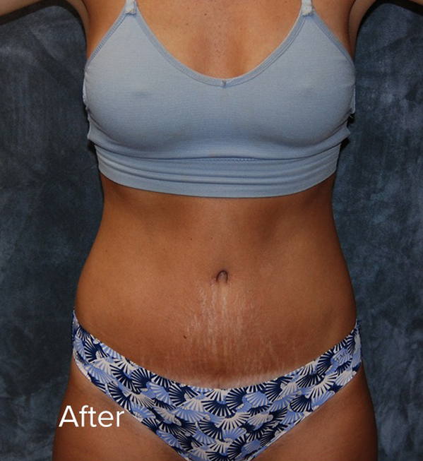 Tummy Tuck