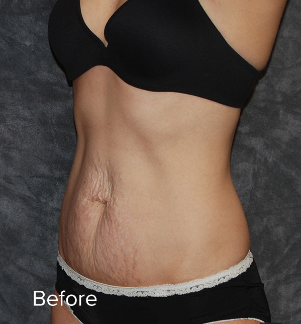 Tummy Tuck