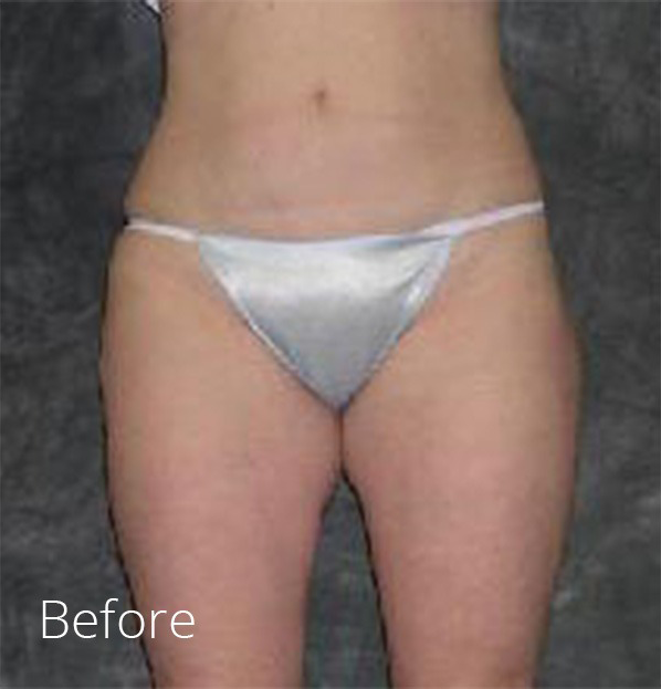 Liposuction