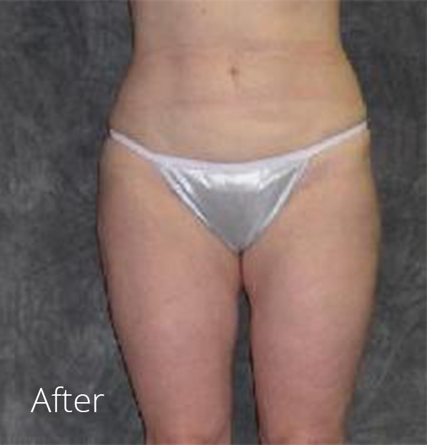 Liposuction