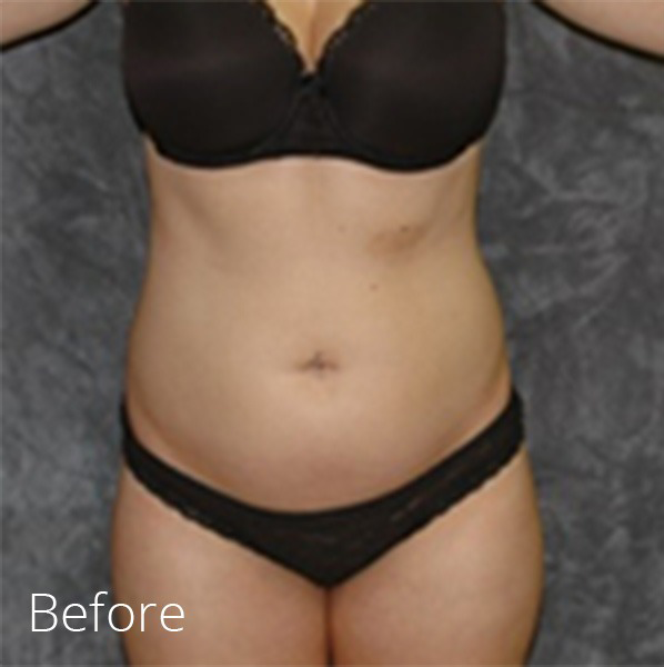 Liposuction