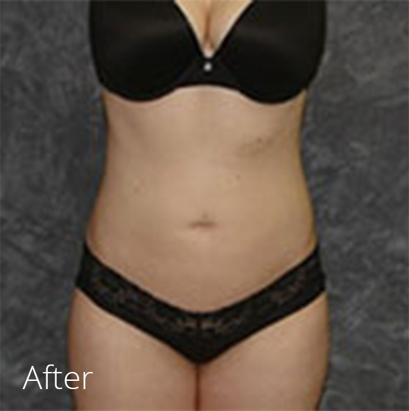 Liposuction