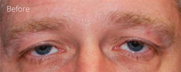 Eyelid Surgery