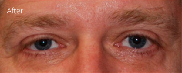 Eyelid Surgery