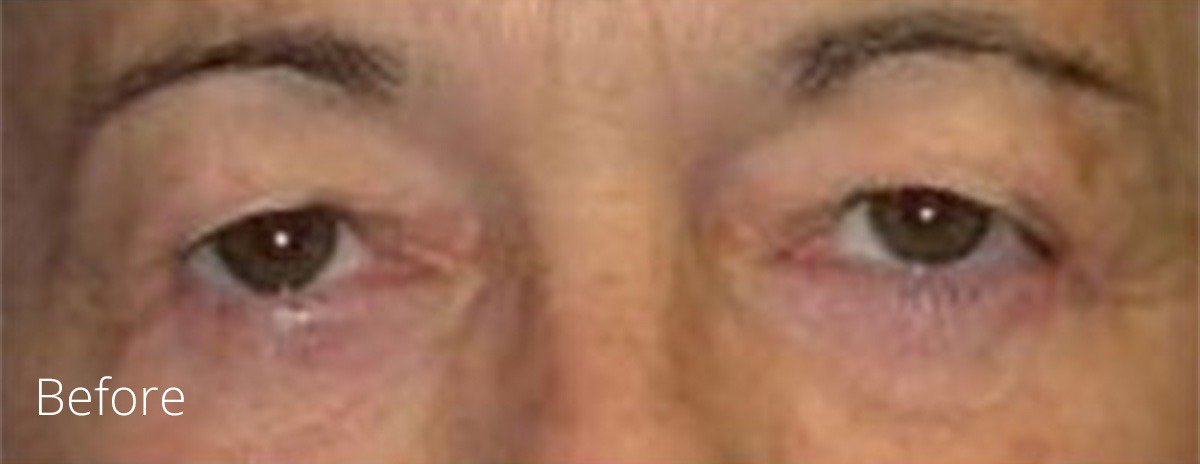 Eyelid surgery procedure before photo