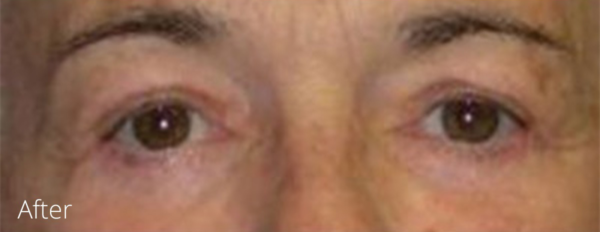 Eyelid Surgery