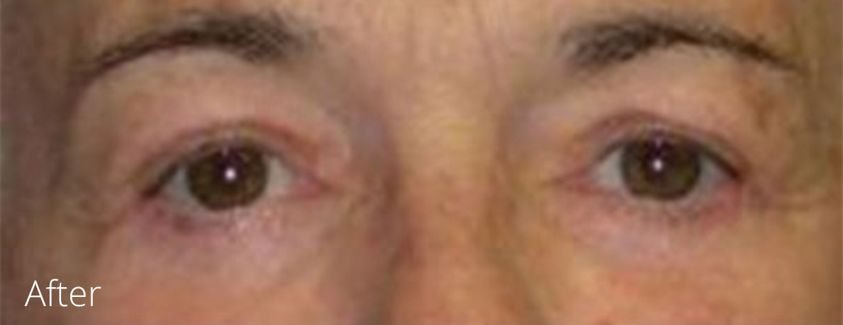 Eyelid surgery procedure after photo
