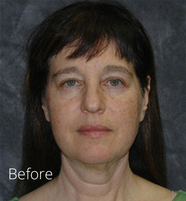 Facelift Before and After Photos Plastic Surgery Photo
