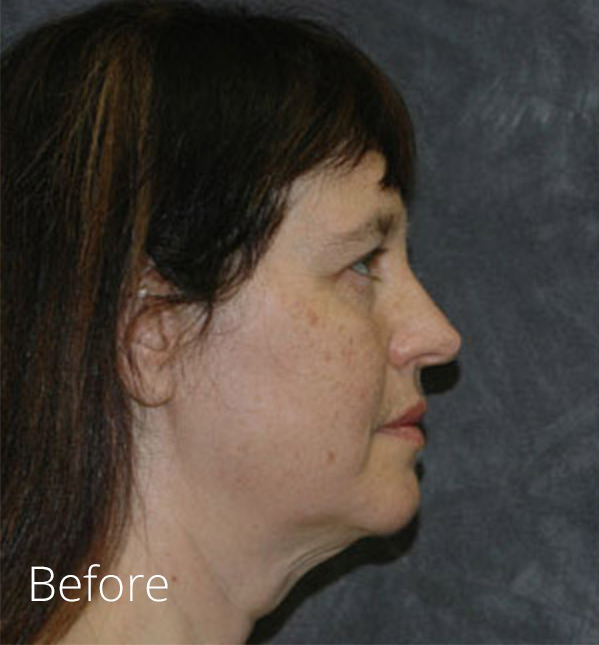 Facelift Before and After Photos Plastic Surgery Photo