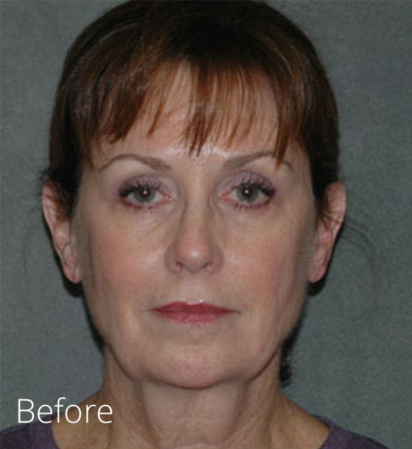 Face surgery procedure before photo