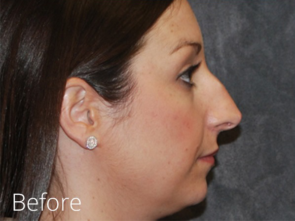 Rhinoplasty