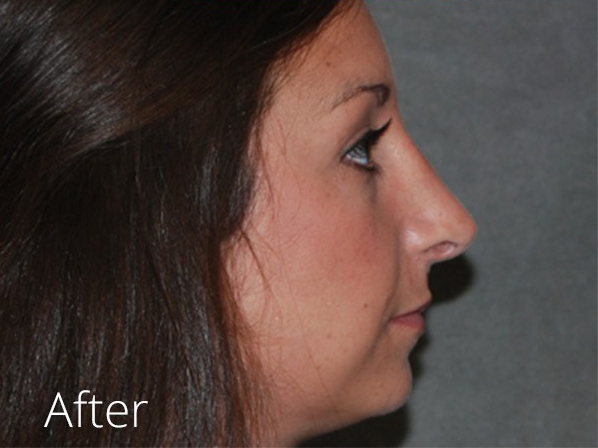 Rhinoplasty