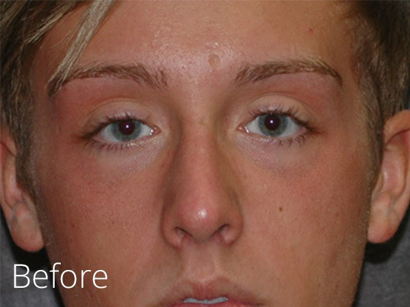 Rhinoplasty