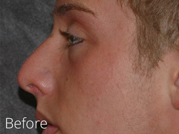 Rhinoplasty