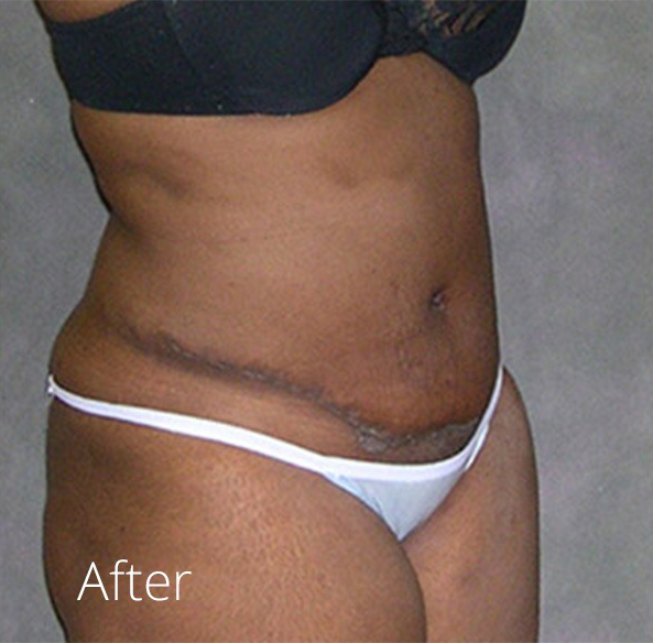 Tummy Tuck