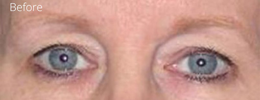 Eyelid Surgery