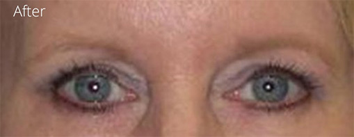 Eyelid Surgery