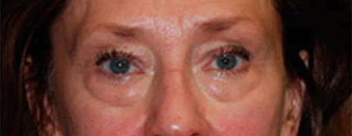 Eyelid Surgery