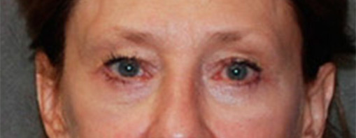 Eyelid Surgery