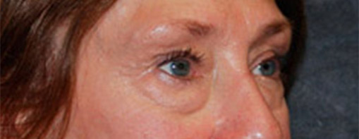 Eyelid Surgery