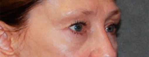 Eyelid Surgery