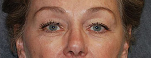 Eyelid Surgery