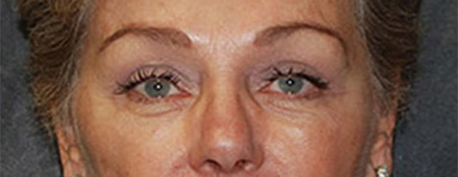 Eyelid Surgery