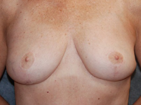 Breast Reduction