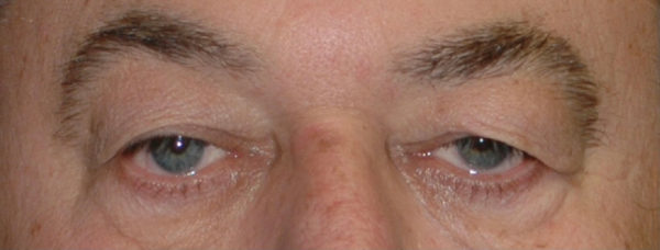 Eyelid Surgery