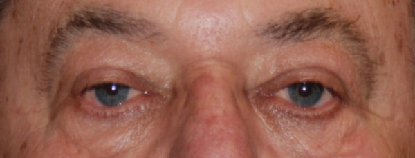 Eyelid Surgery