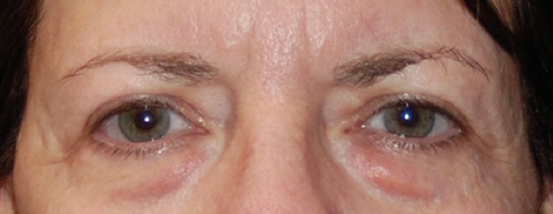 Eyelid Surgery