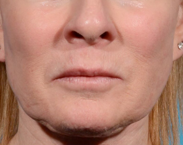 Morpheus8 Before and After Results