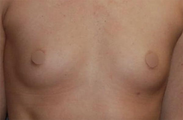 Breast Augmentation