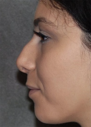 Rhinoplasty