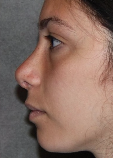 Rhinoplasty procedure after photo