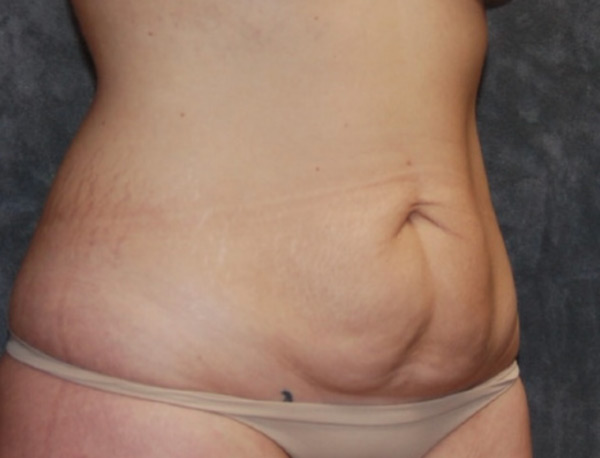 Tummy Tuck