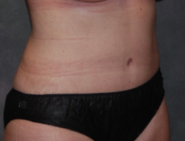 Tummy Tuck