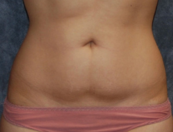 Liposuction