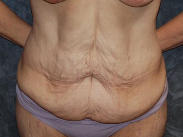 Tummy Tuck