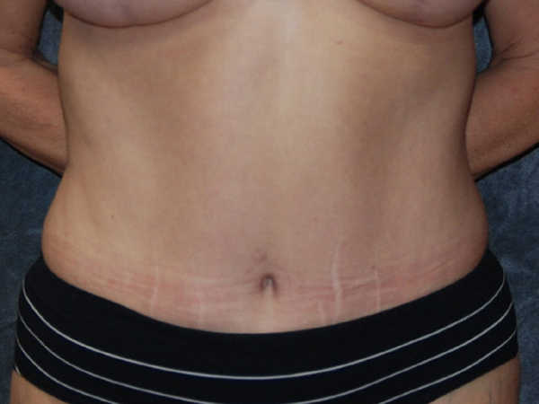 Tummy Tuck