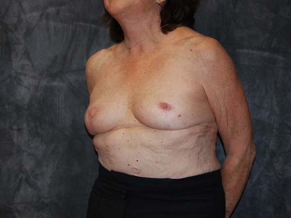 Breast Reconstruction