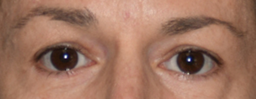 Eyelid Surgery