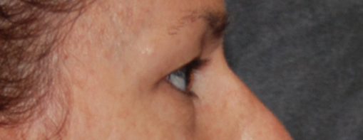 Eyelid Surgery