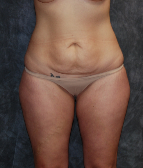 Liposuction