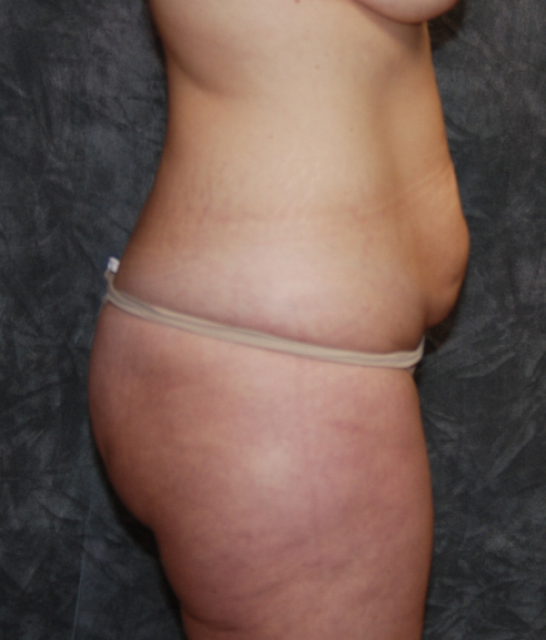 Liposuction